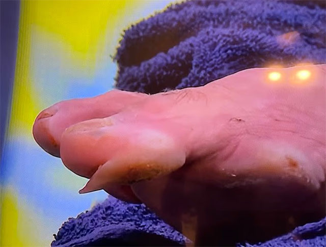 Cận cảnh vết thương ghê rợn của Djokovic