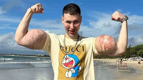  'Quái vật phòng gym' trả giá đắt vì bơm hoá chất vào 2 bắp tay