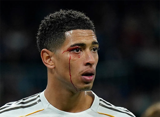 Bellingham chảy toang máu, còn bị thẻ vàng khi muốn vào sân quá nhanh sau chấn thương